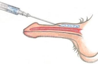 Nevarna metoda povečanja penisa z injekcijami vazelina